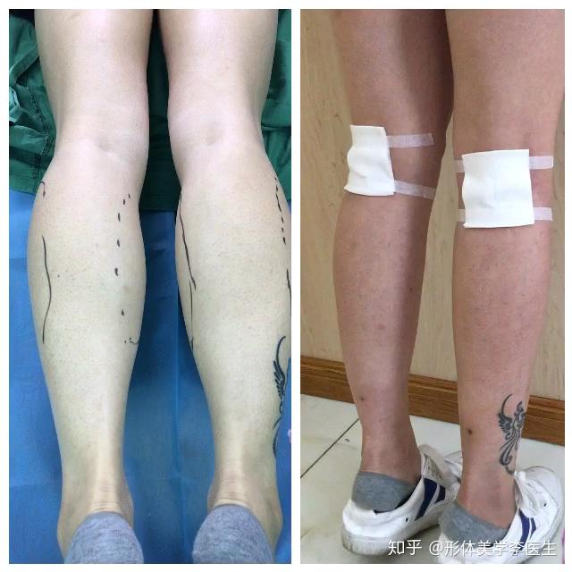 术后小腿肌肉由紧绷状态变为松弛状态,肌肉变软,手感柔和,线条圆润