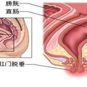 管理百科讨论精华视频等待回答简介肛门脱出并不就是单纯的脱肛;脱肛