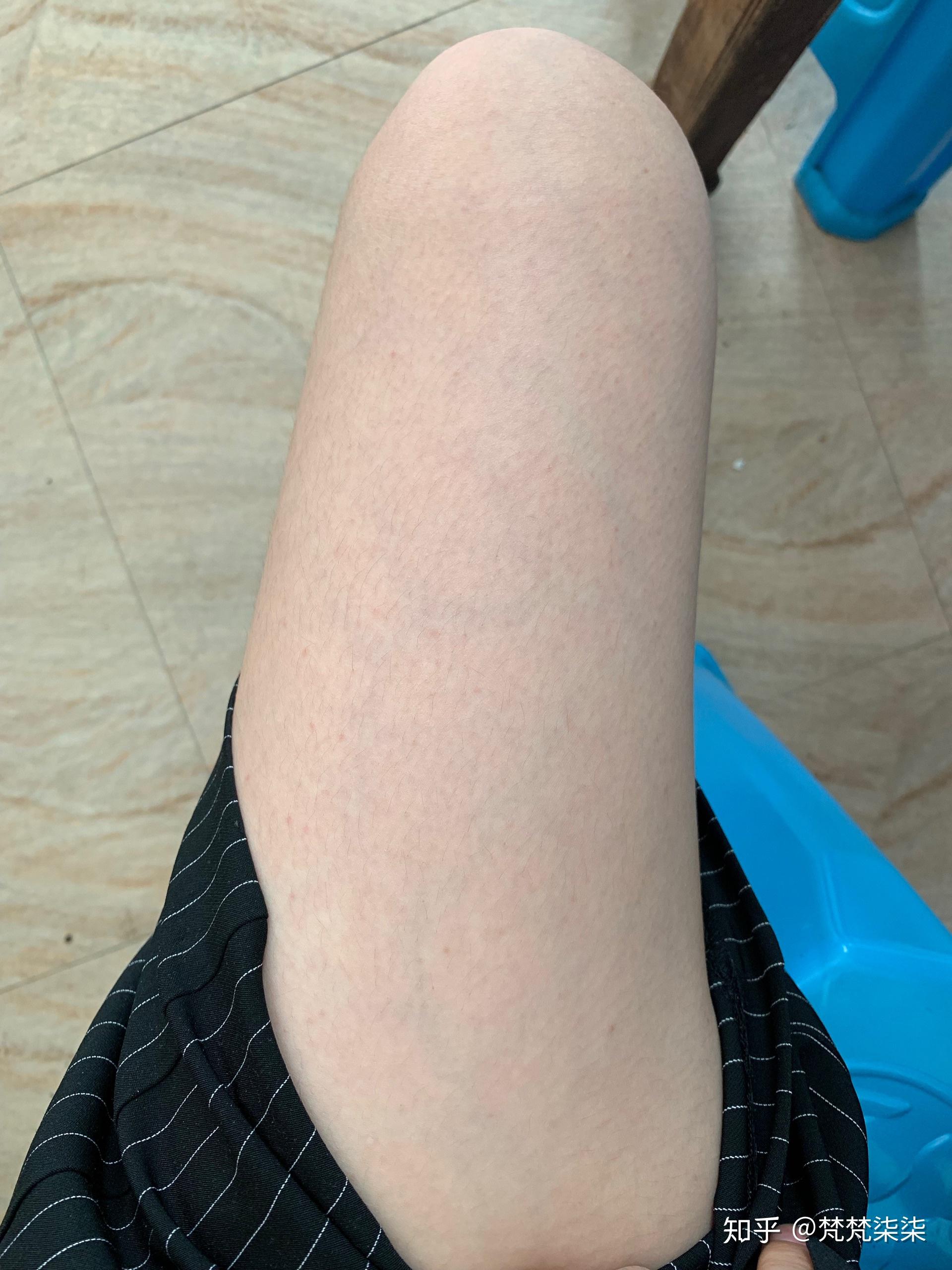 请问全身血管明显是怎么回事