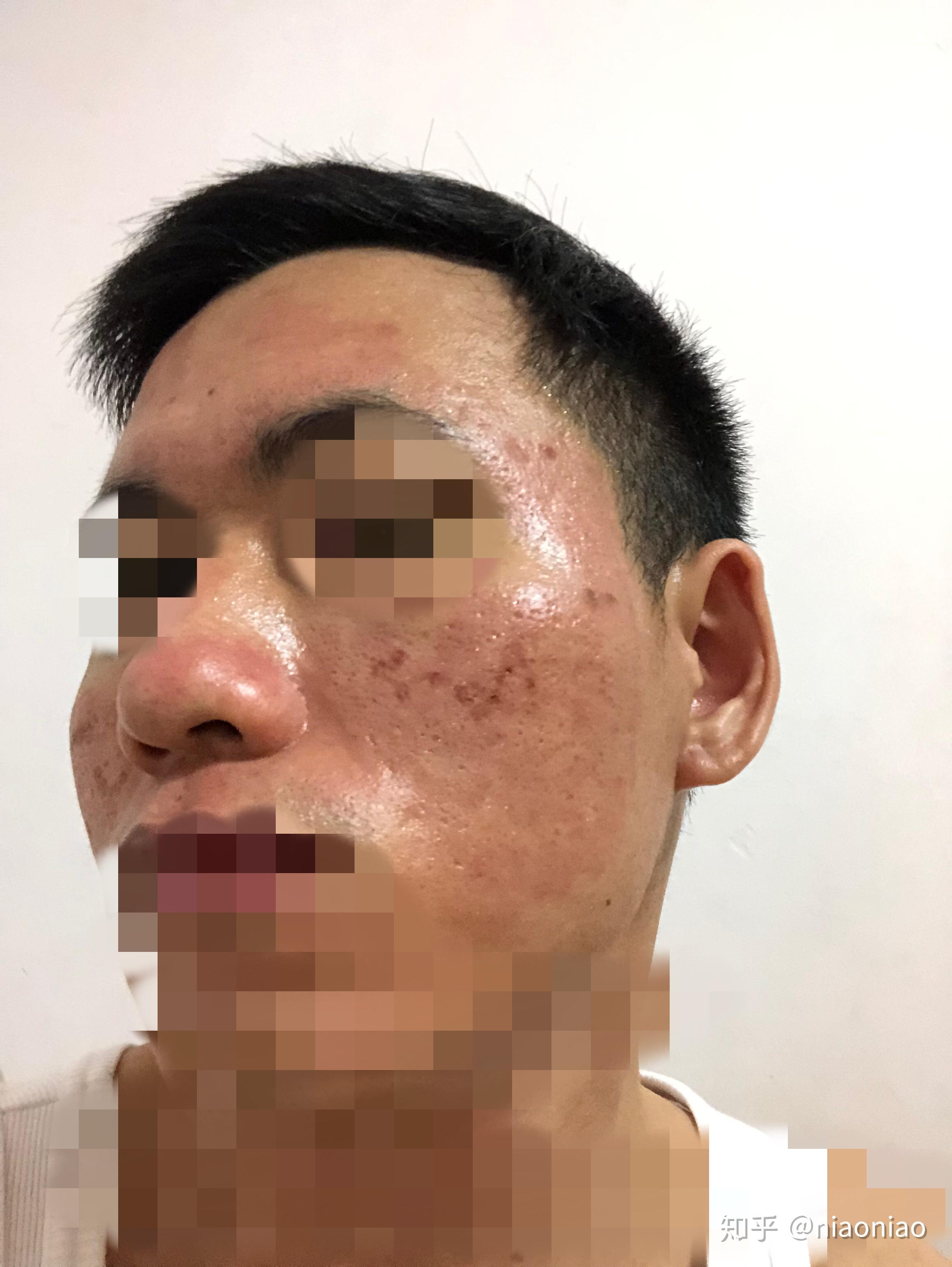 记录第一次点阵激光祛痘坑