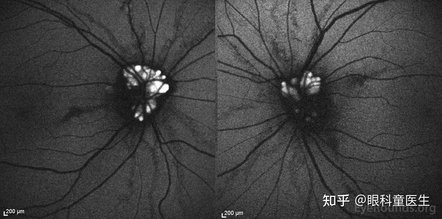 血管壁玻璃样变性图片