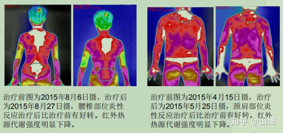 红外热成像及血流图图片