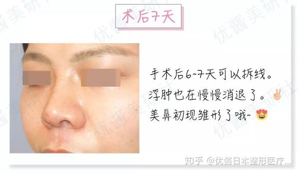 10年后 我会感谢下定决心整鼻子的自己 鼻整形术后攻略 知乎