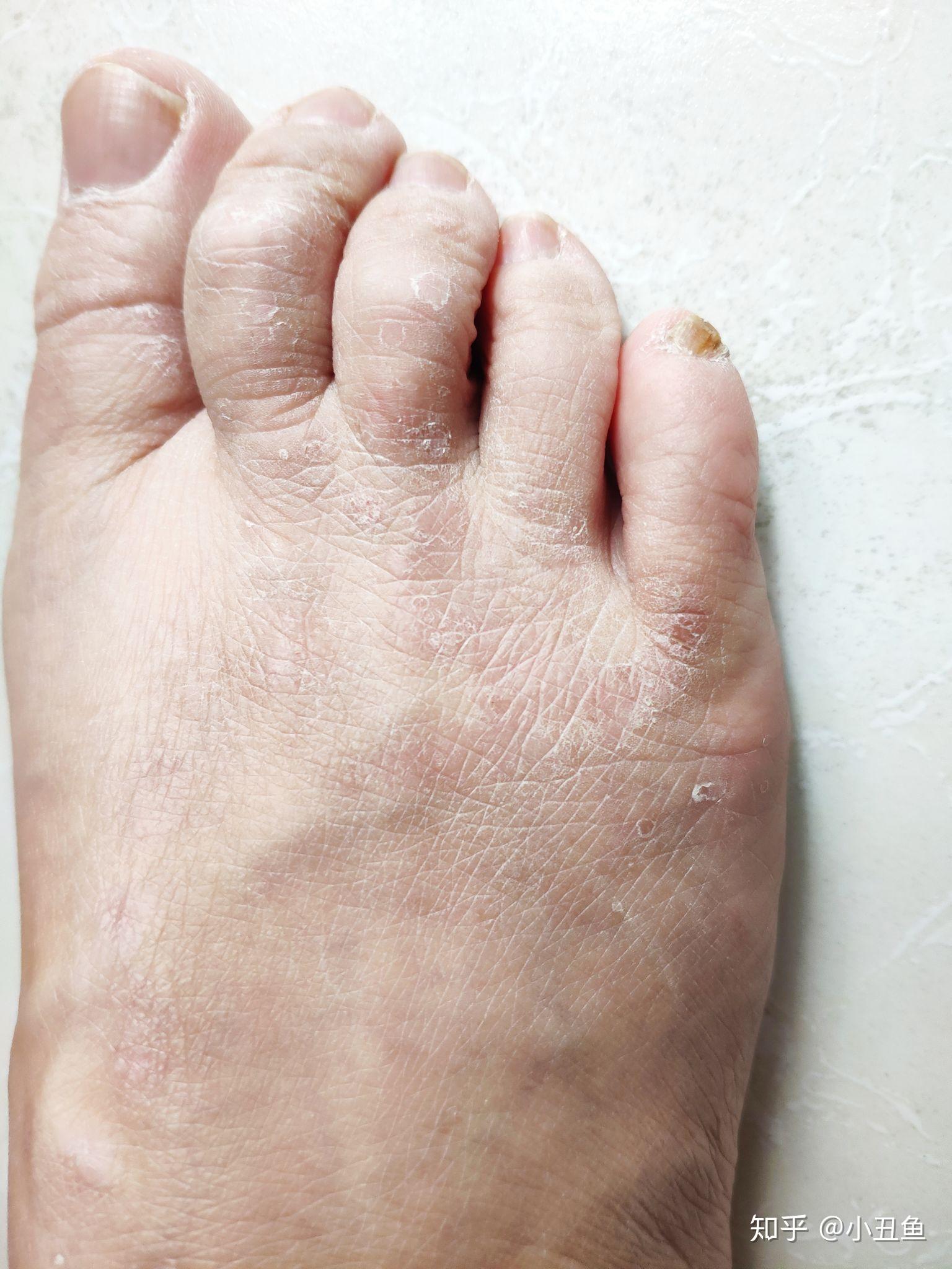 连续四年每到夏天双脚脚面就犯湿疹有没有办法根治