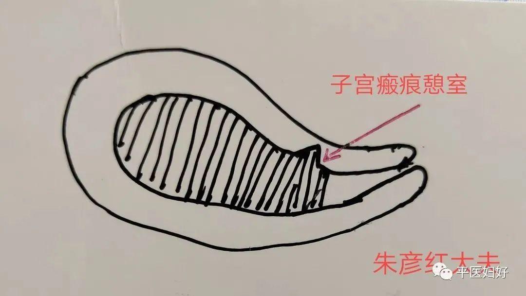 子宫多了个小房间! 小憩室,大危害!