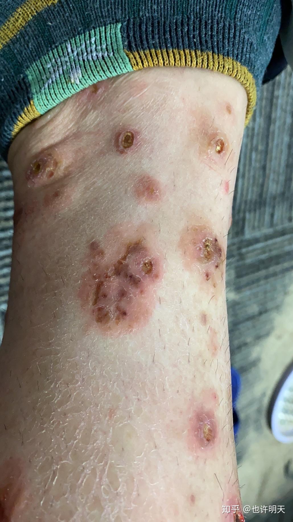 变应性皮肤血管炎怎么治疗危害大不大