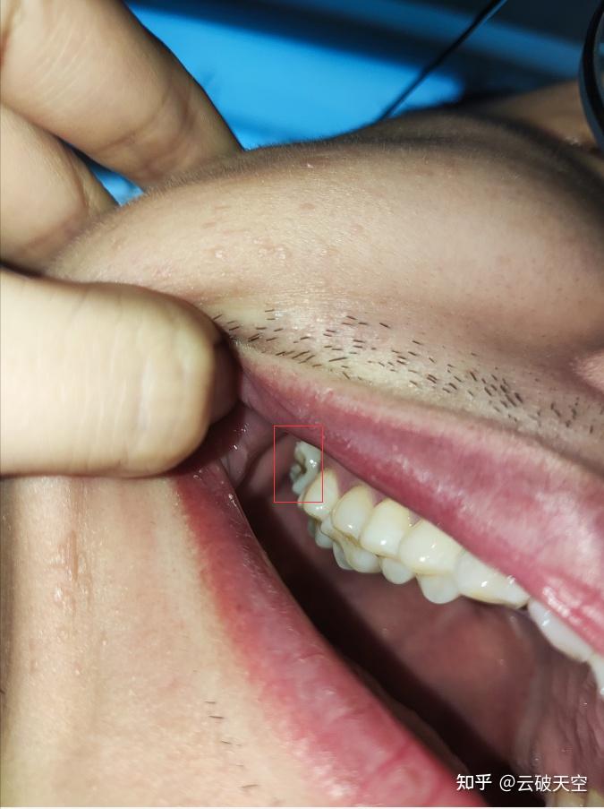 智齿一定要拔掉吗