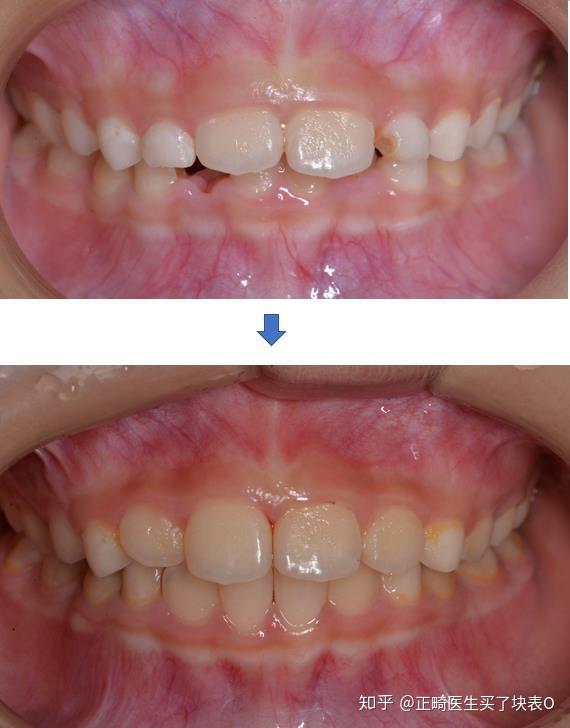 哪位大神能说下芬兰罗慕齿美康对早期幼儿牙齿矫正有没有作用