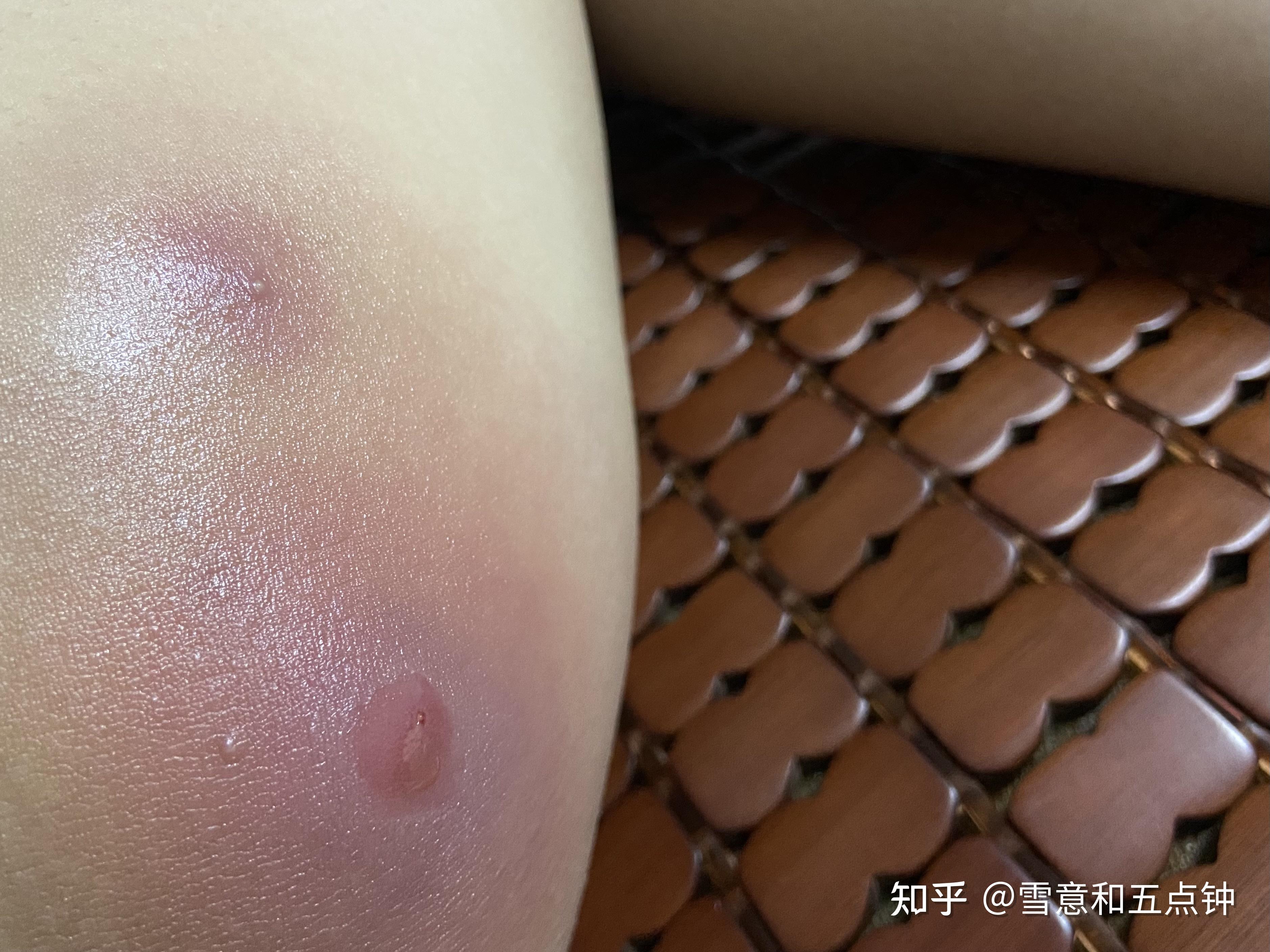 大腿内侧长了个疙瘩,按着有点疼,硬硬的,用不用看医生啊? - 知乎