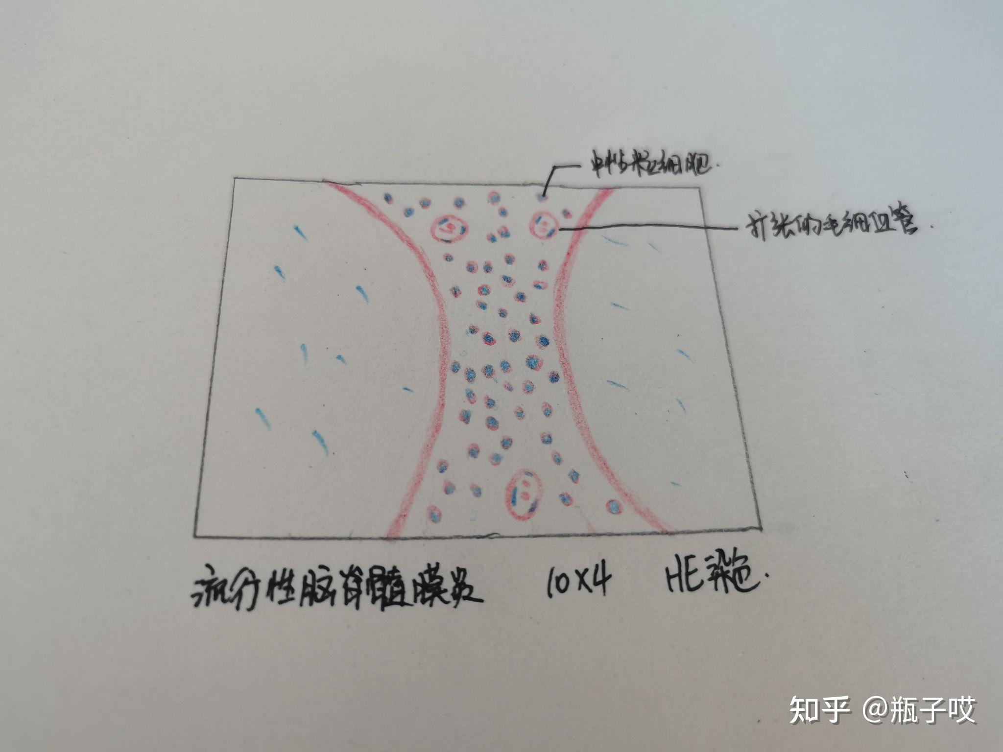 流行性腦脊髓膜炎病理紅藍鉛筆繪圖