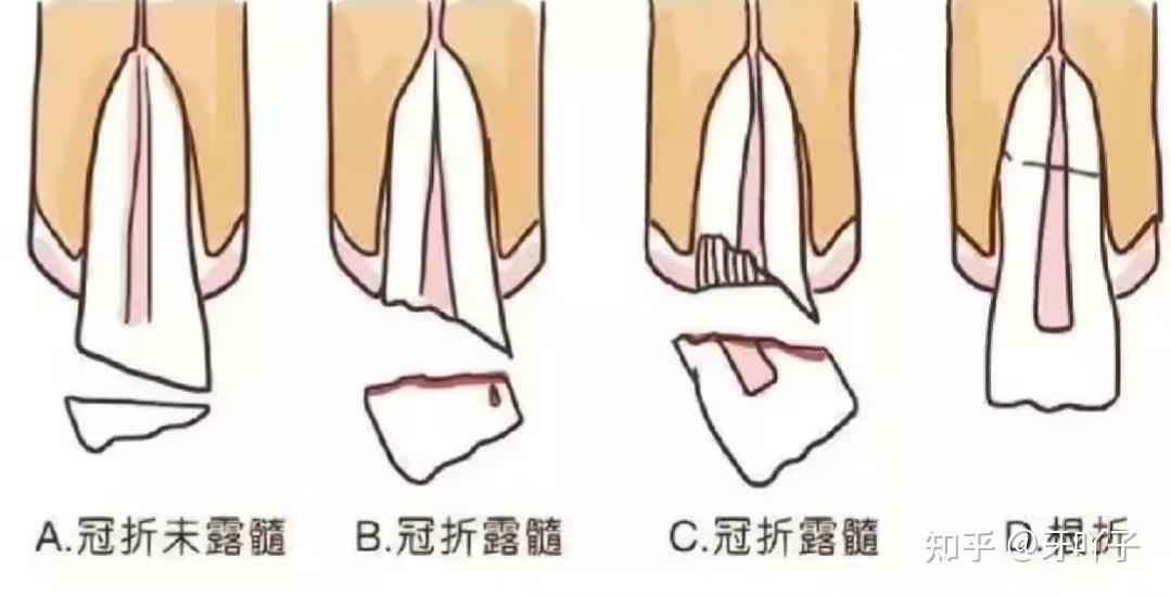 牙齿外伤后怎么治疗?延迟修复和即刻修复区别大吗? - 知乎