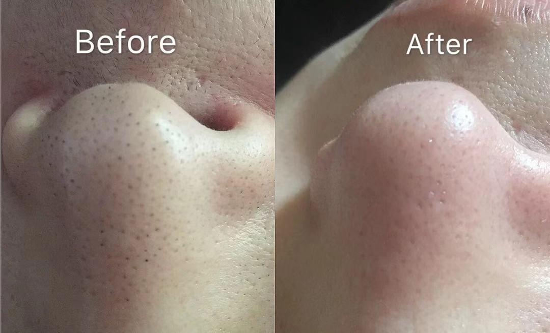 你们闭口粉刺都是怎么怎么解决的