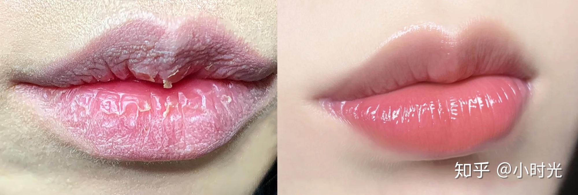 嘴唇总是干燥起死皮怎么办