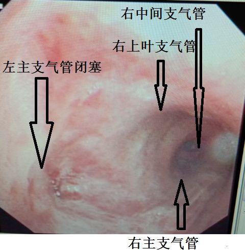 图13 气管镜检查我当时还想着左主支气管应该有条缝隙,没想到,做纤支