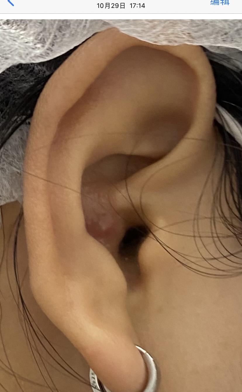 外耳道疖肿切开排脓图片