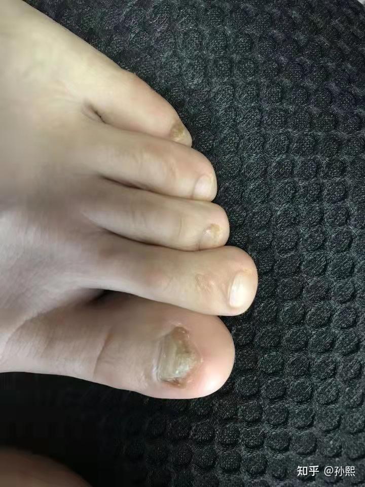 指甲分层到底是怎么回事啊到底是不是灰指甲啊