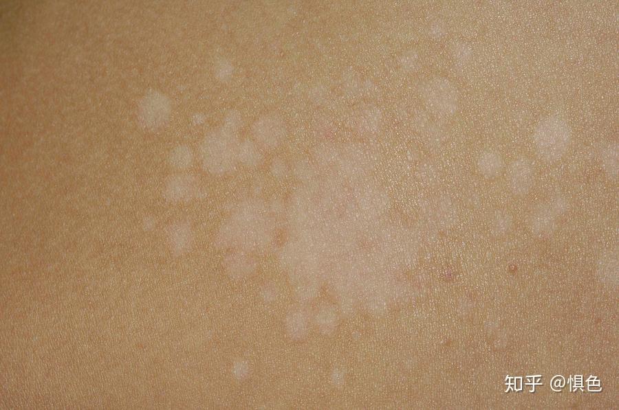 不斷向外擴展,中心消退(色素沉著):環狀,多環狀花斑糠疹 pityriasis