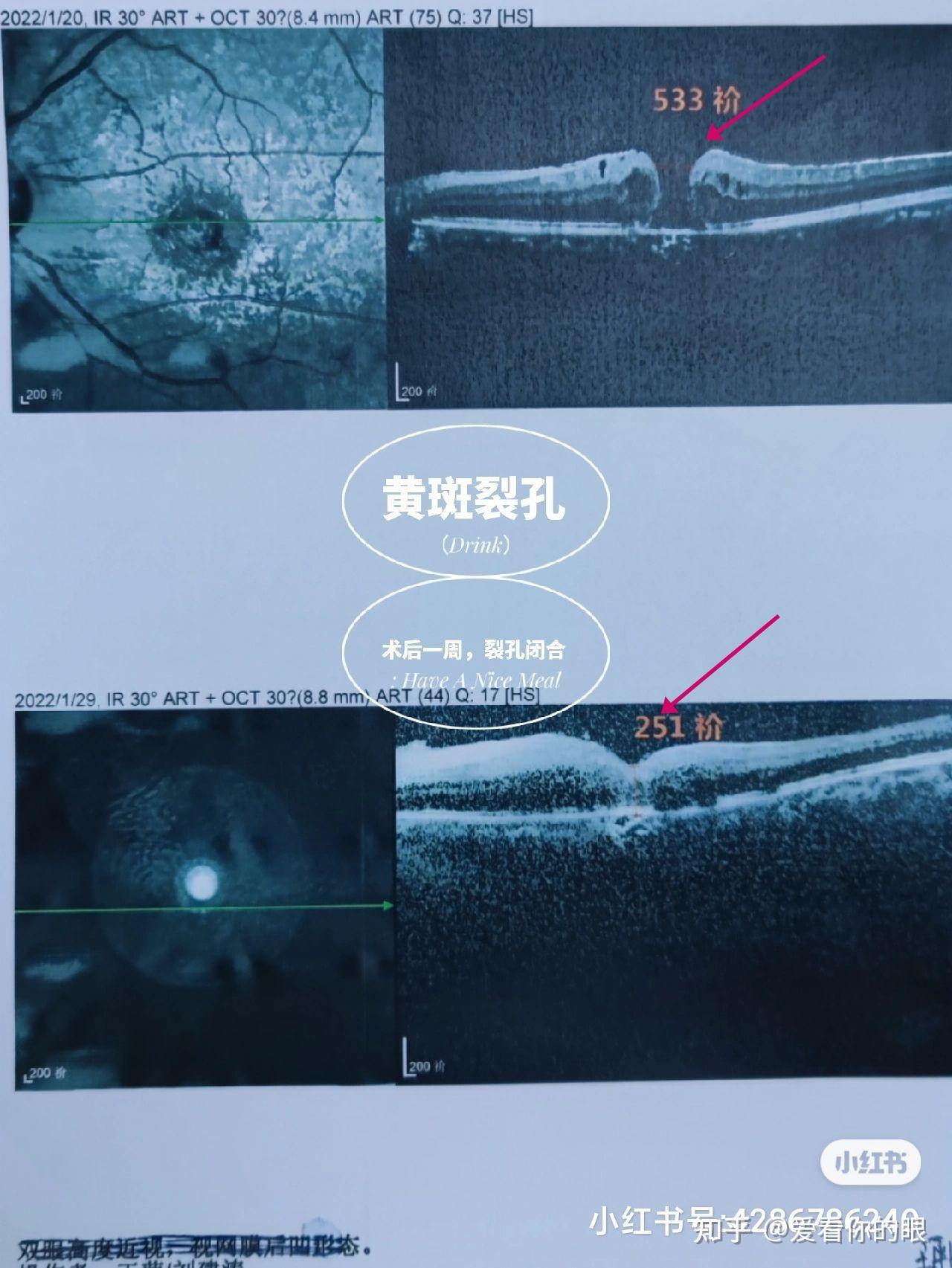 黄斑裂孔1至4期图片图片
