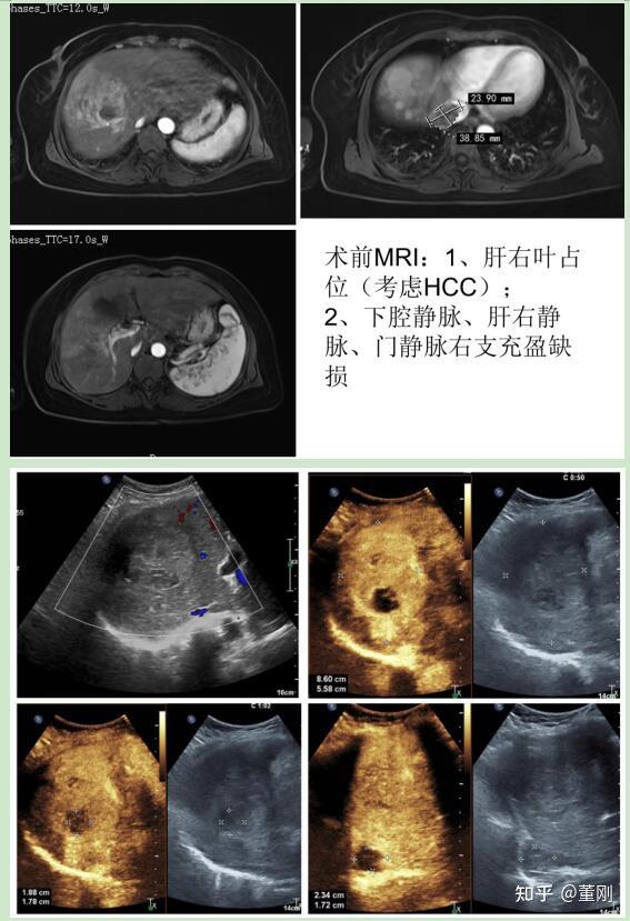 转移性肝癌超声图片图片