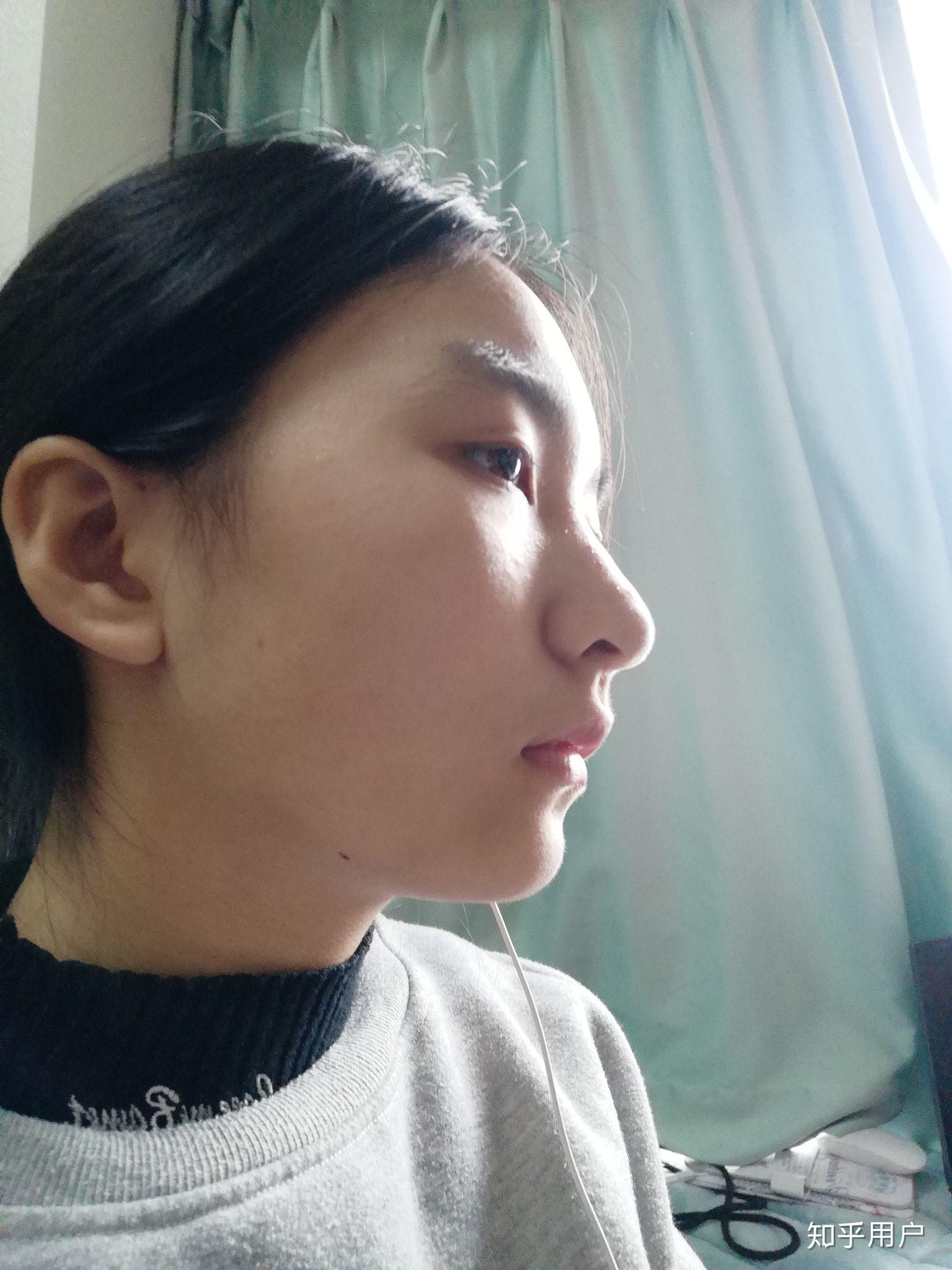 怎么把鼻梁 山根变高,脸变瘦?