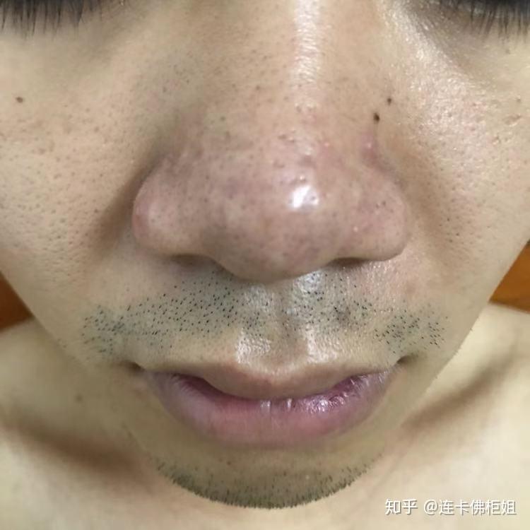 70以上角栓画像 画像のダウンロードに関するブログ