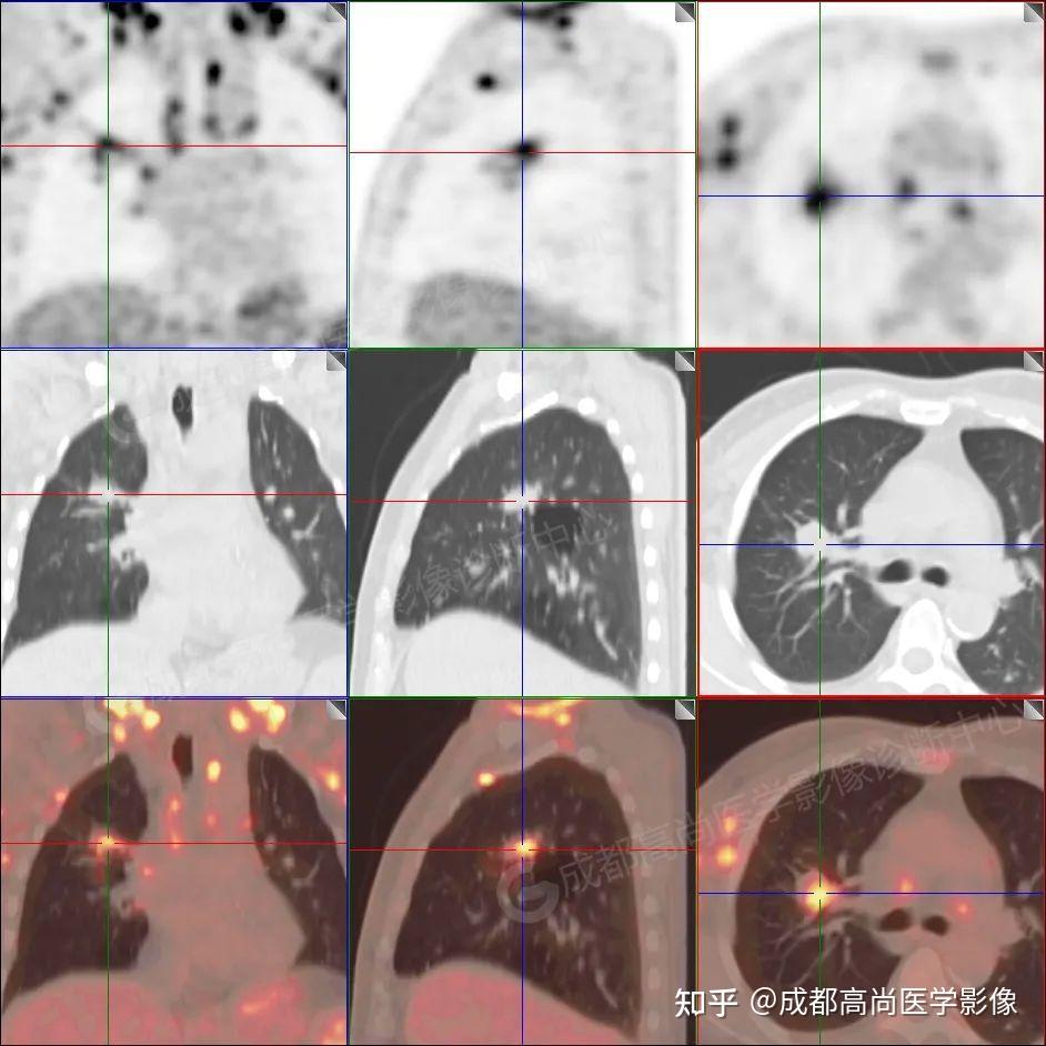 【高尚病例】全身多部位结核PET/CT显像一例 - 知乎