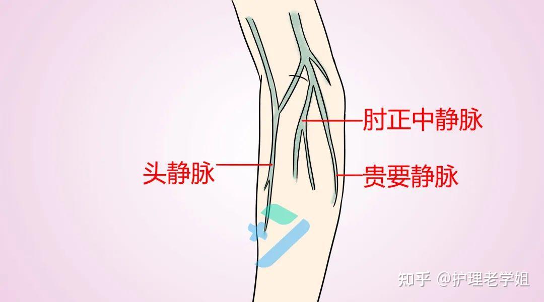 在此区域进行静脉穿刺,针头刺激到神经的概