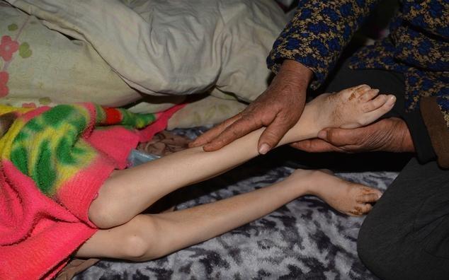 下肢术后80的患者会出现的病症肌肉萎缩医生这一招可解决