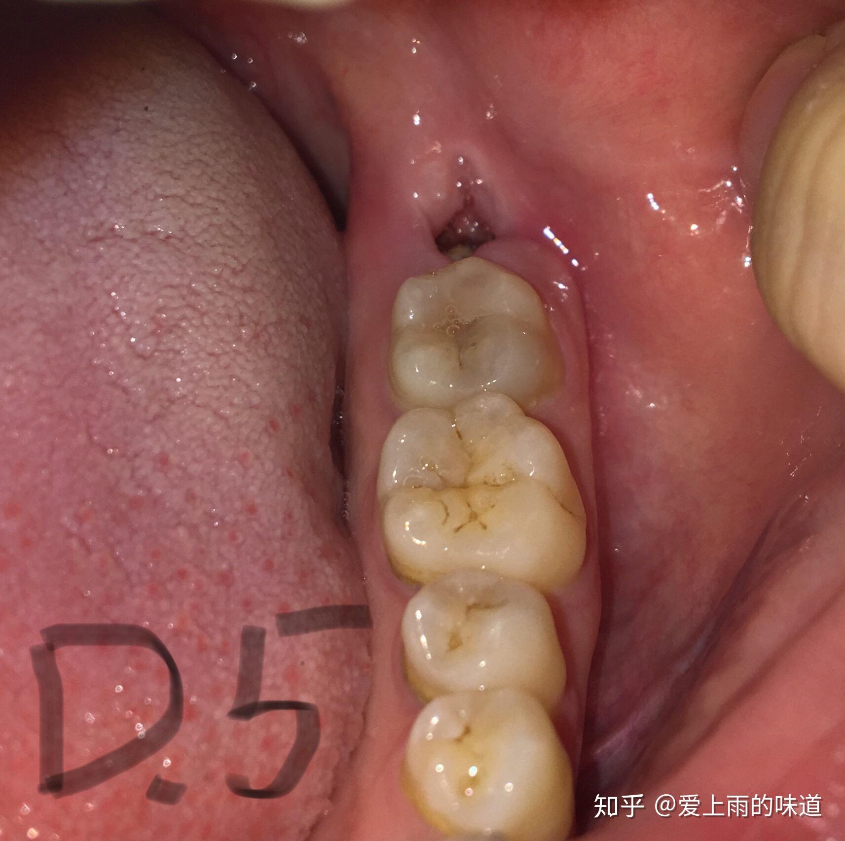 拔智齿后,你吃什么?愈合过程记录?