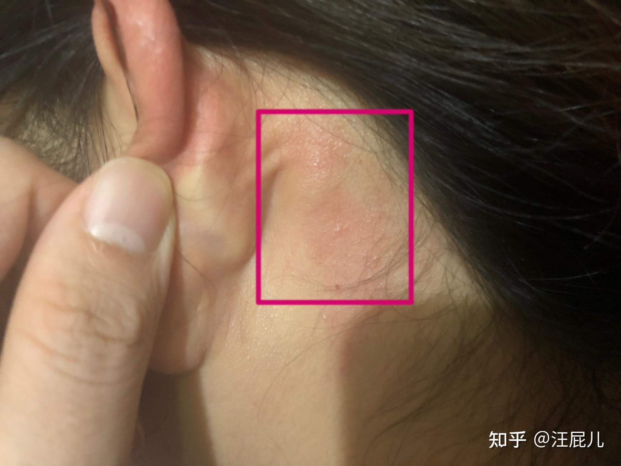 耳朵后面长硬包? - 知乎