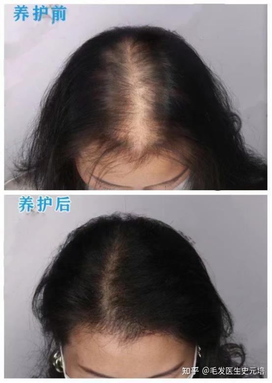 为什么女性发缝处位置更容易脱发呢? - 知乎