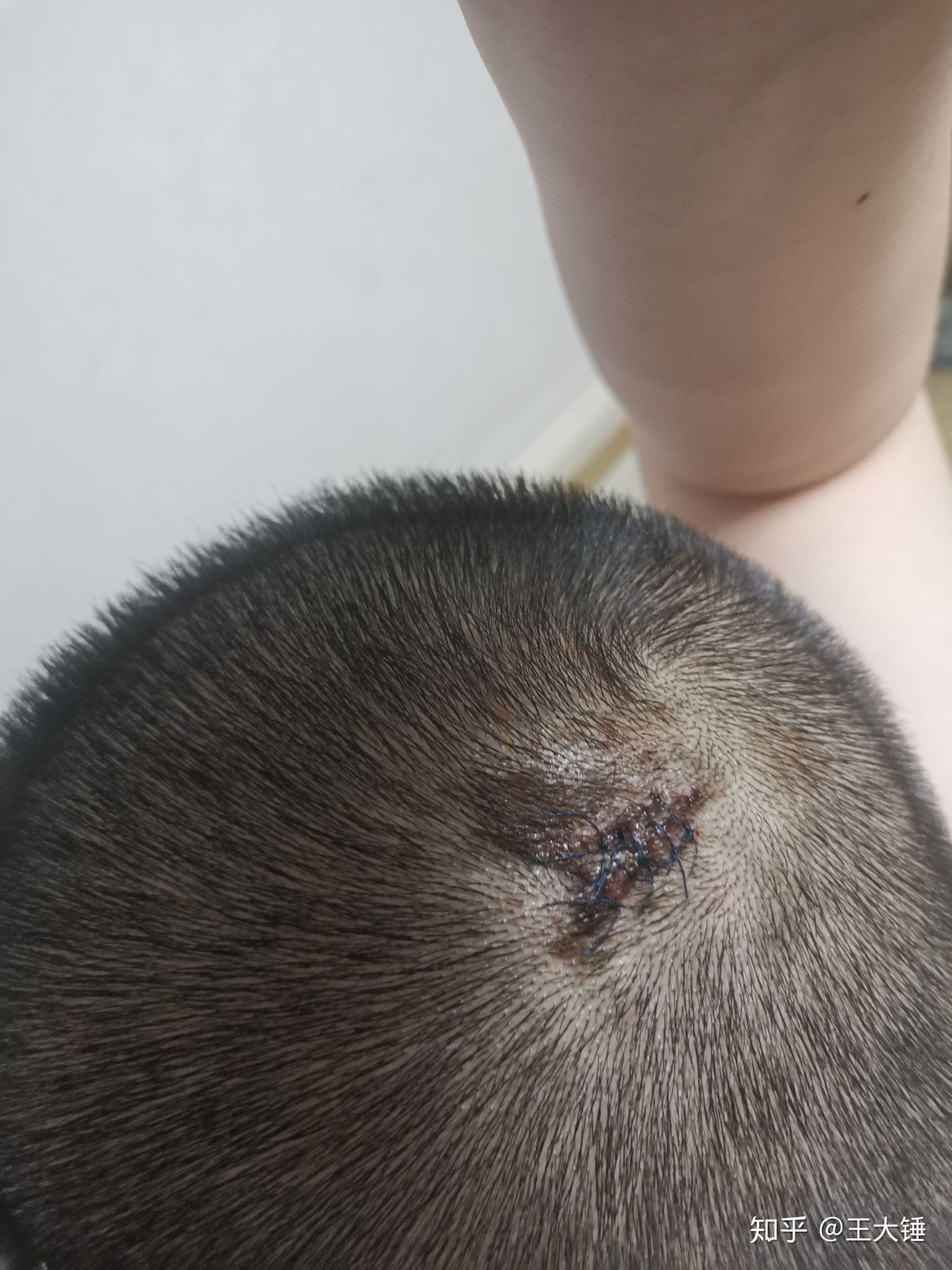 缝针和拆线可怕吗?疼吗?你们当时怕吗? - 知乎