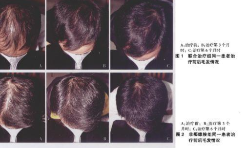 发际线变高还能变回去吗?具体怎么挽救? - 知乎