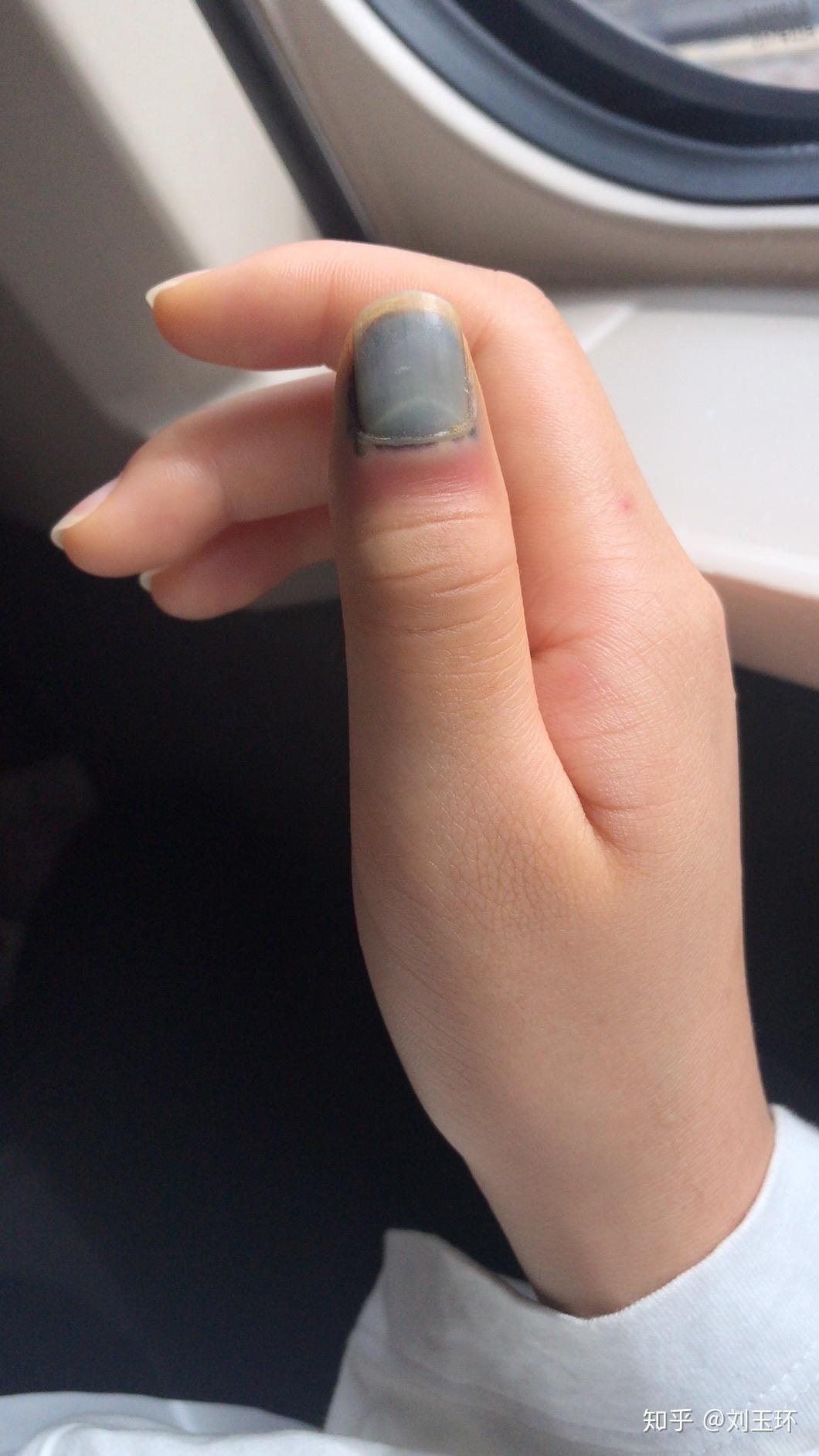 被车门夹到手指了,一篇文章教你到底要不要选择拔指甲?