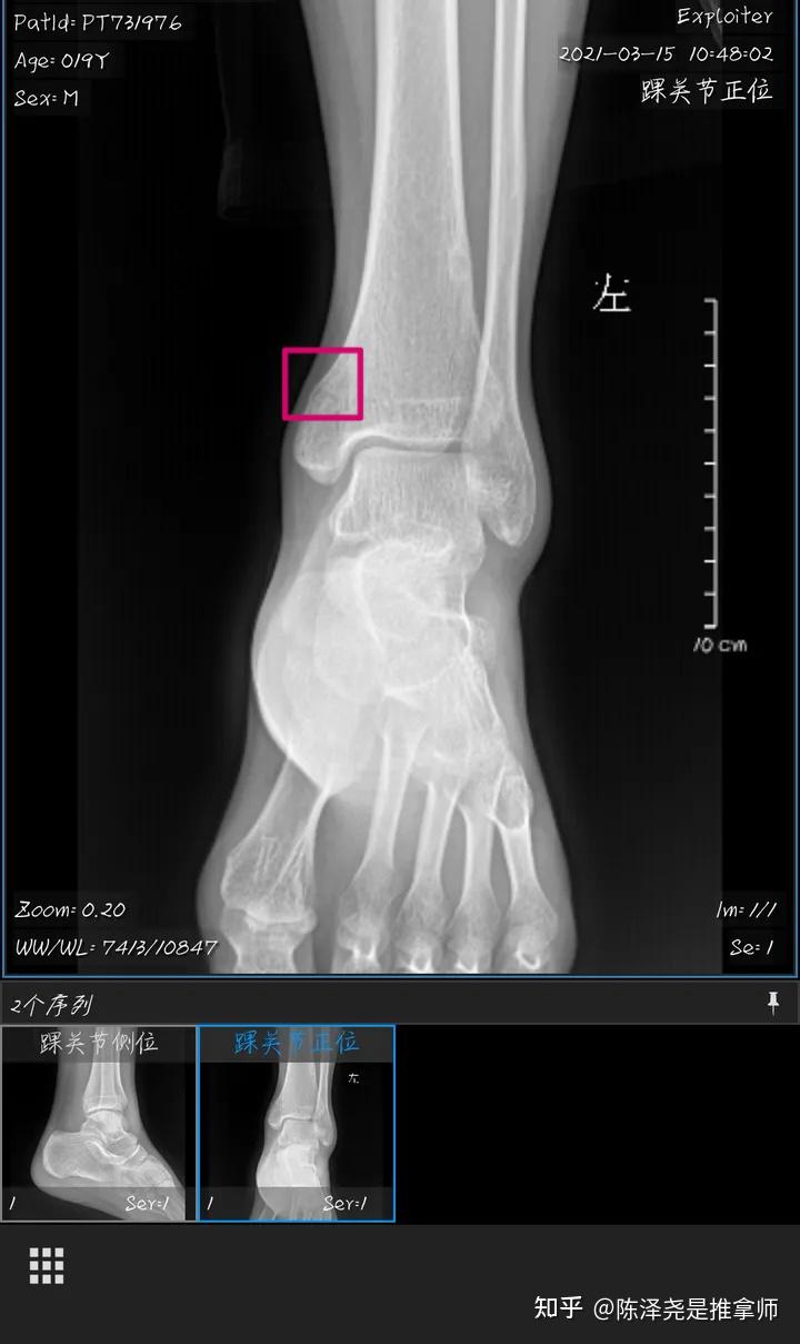 我这样是哪里可以给我圈一下吗只知道是坐内踝骨折