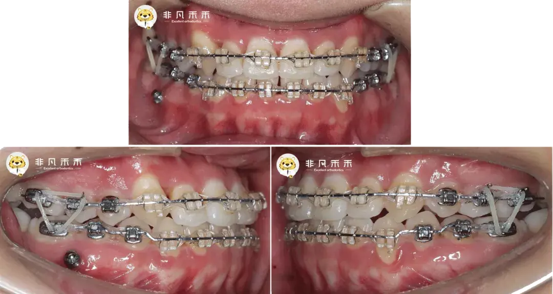 正畸病例嘴突地包天反病例一例