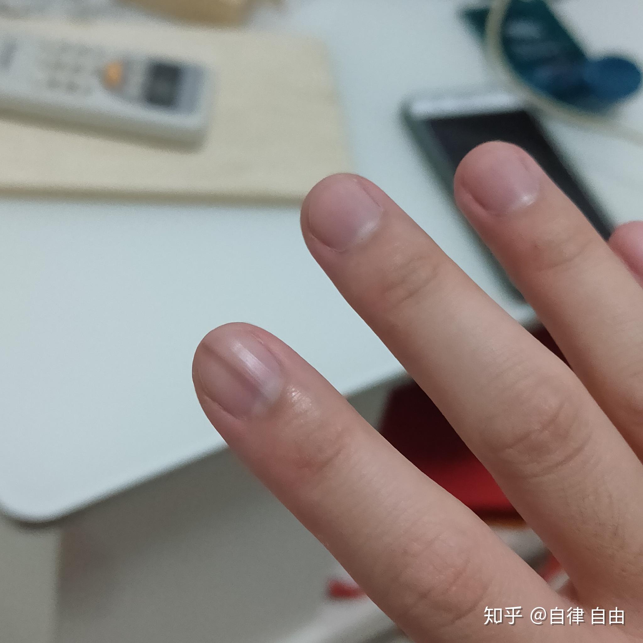 左手大拇指指甲有一条淡褐色竖线好几年了微量元素也正常为什么啊