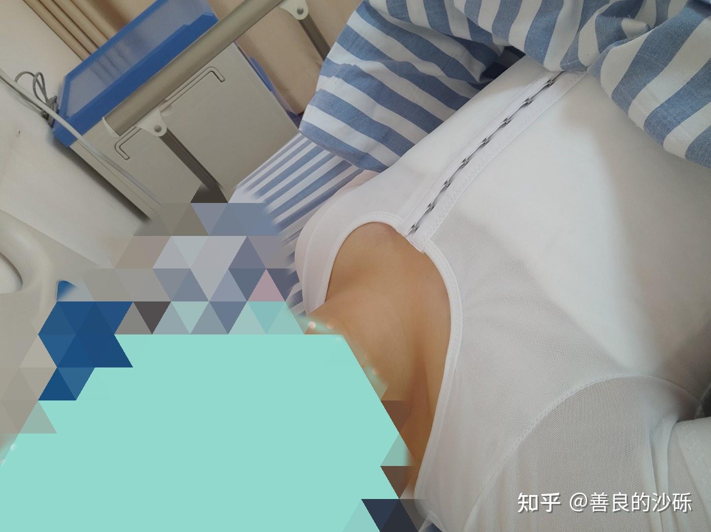 男性乳腺发育症手术图片