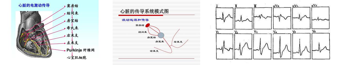 博声医疗 完全性右束支传导阻滞 知乎