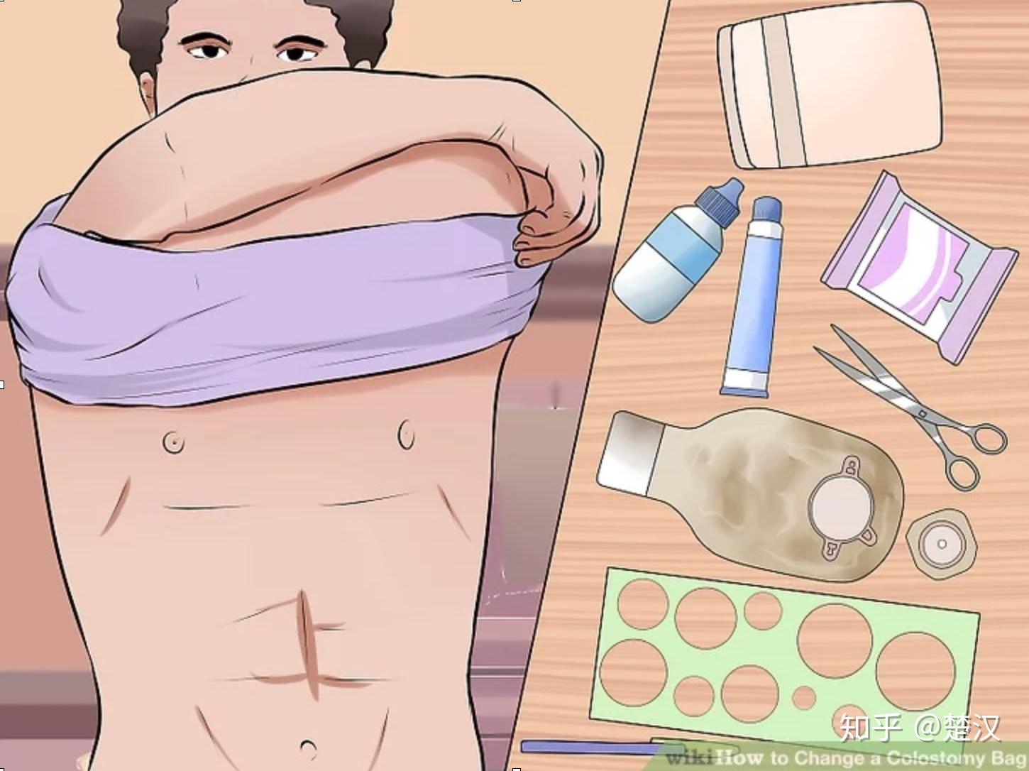 如何更换造口袋