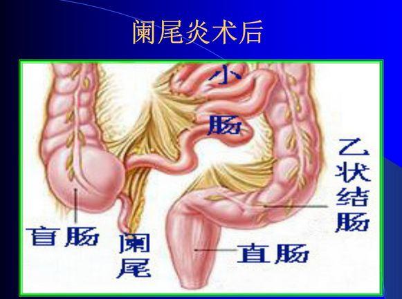 阑尾炎一定要手术吗?不做手术行不行?