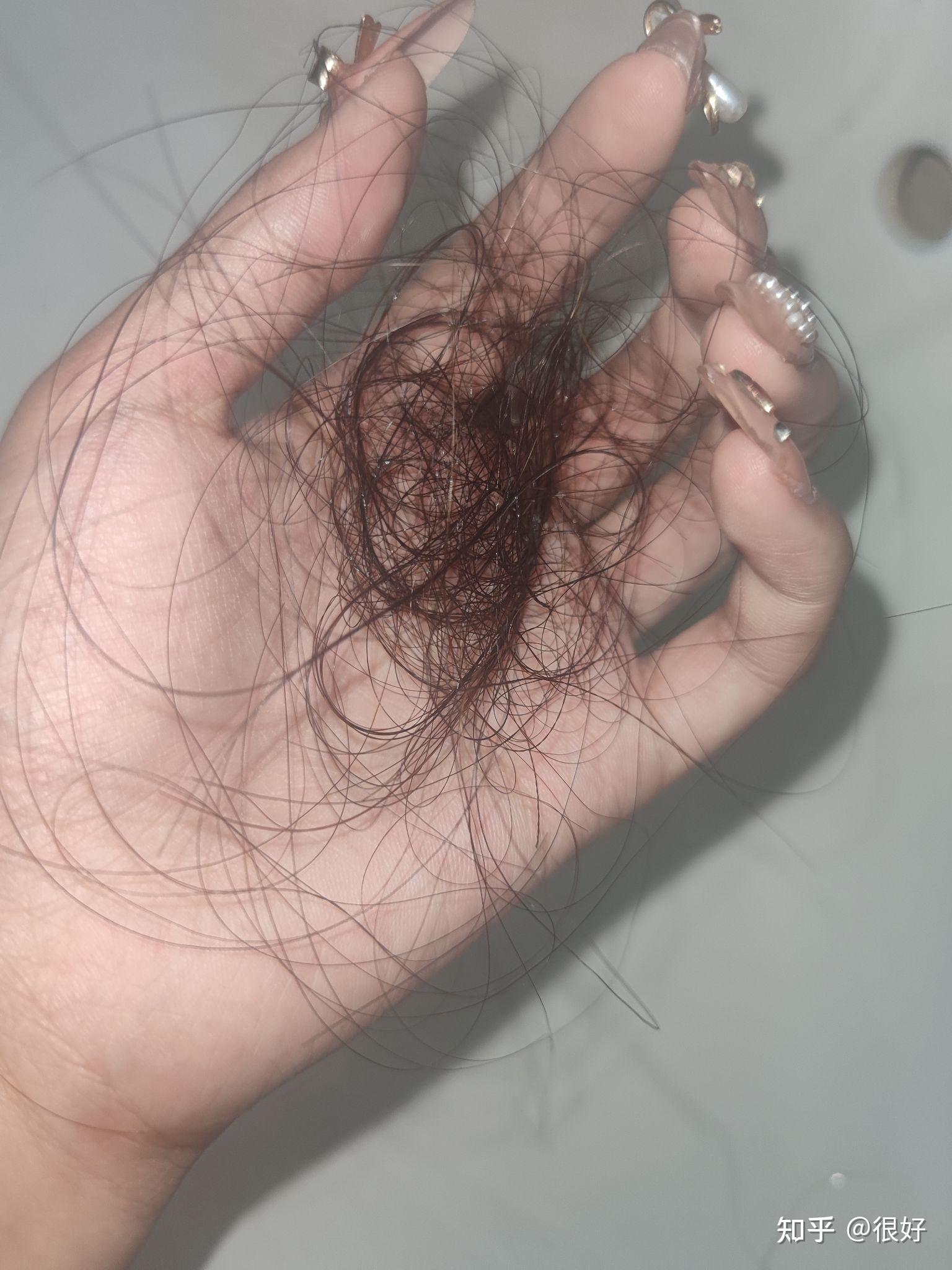 脱发,发量少影响到你了吗?