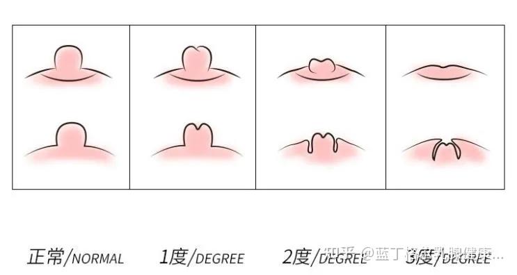 女性乳头 正常 色泽图片