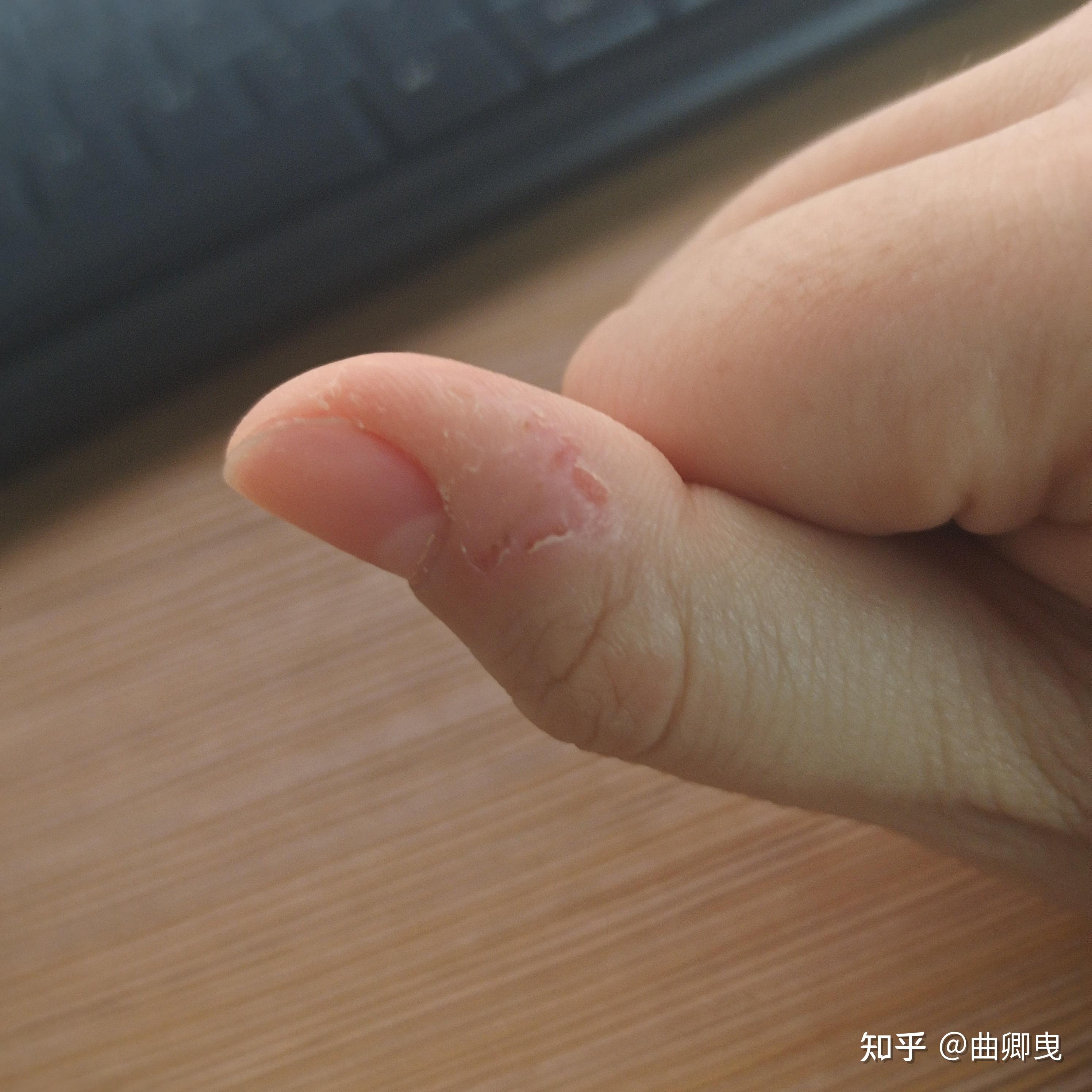 大拇指指甲旁边干裂掉肉,如图所示,求帮助. - 知乎