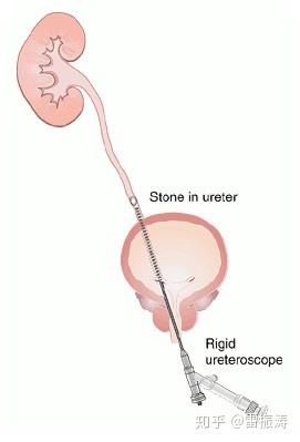 输尿管结石微创手术那些事