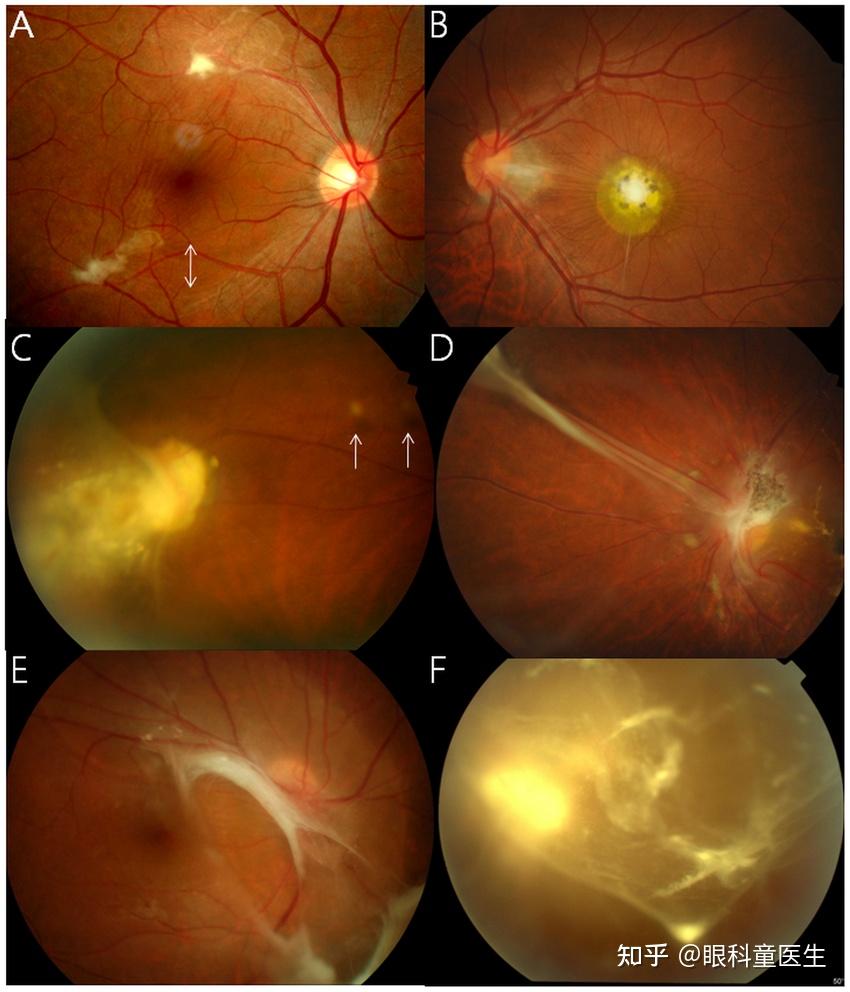 眼弓蛔虫病(ocular toxocariasis)