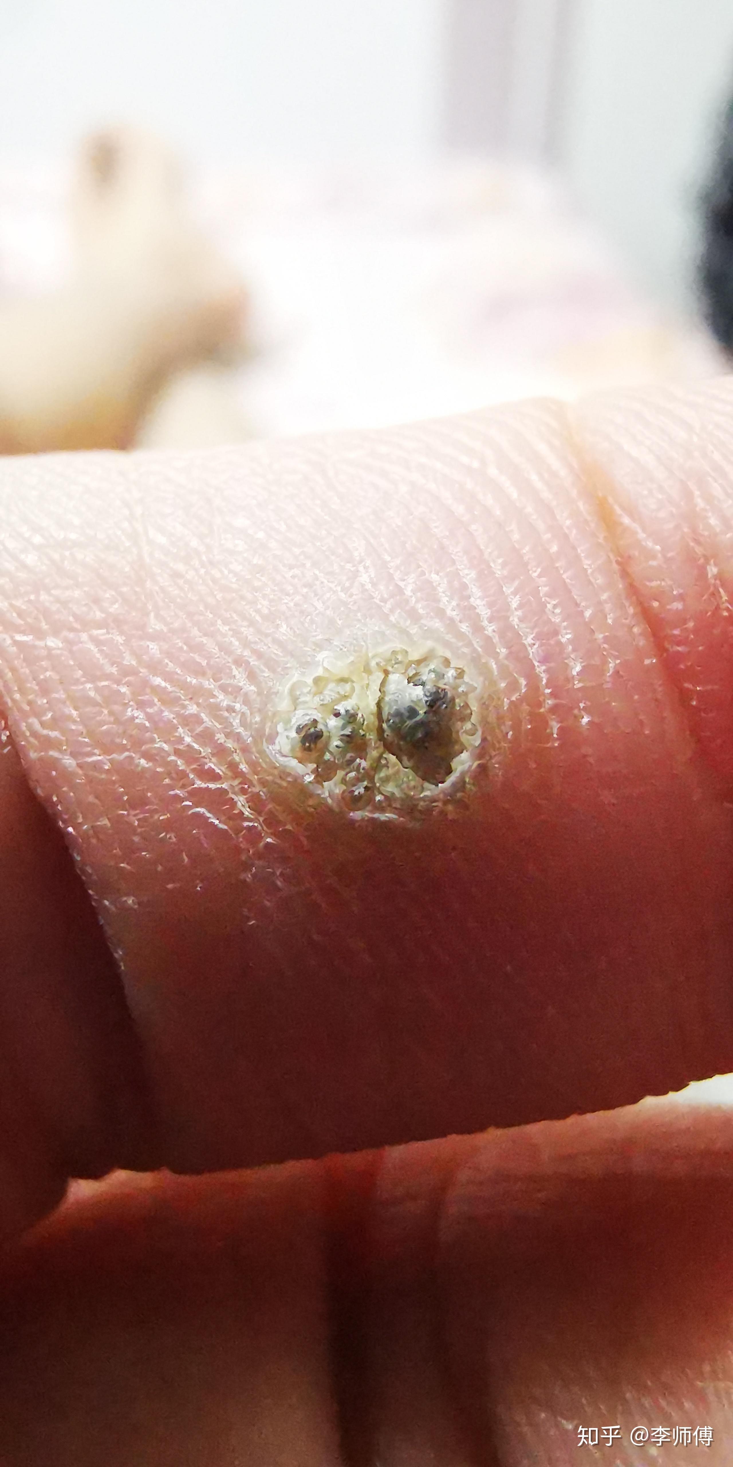 有人脚上长过跖疣么怎样能根治呢我快痛苦死了