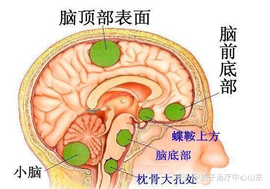 脑膜瘤可以用质子治疗吗？ 知乎