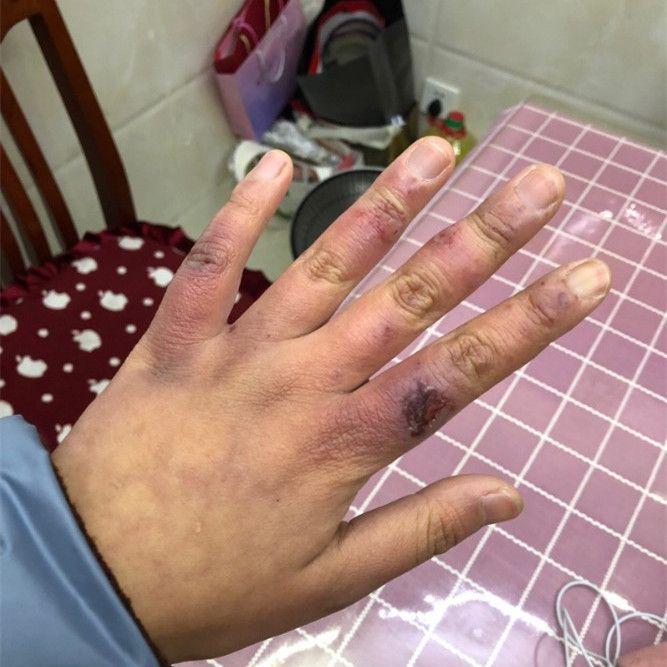 冻手冻脚怎么办