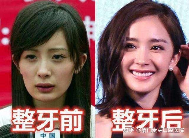 很多大牌明星,在刚成名的时候,牙齿都不齐,比如杨幂,高圆圆,胡歌,唐艺